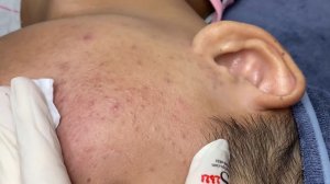361 • Acne collection • АСМР • Relax Spa