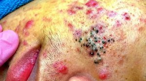 Удаление черных точек с Sac Dep Spa