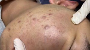 363 • Acne collection • АСМР • Relax Spa