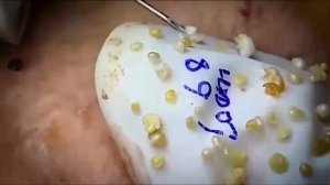 #1 Удаление комедонов, угрей и прыщей — глубокое очищение кожи