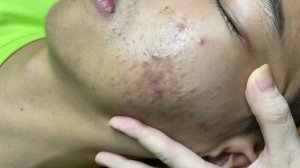 Подростковые комедоны – механическое удаление