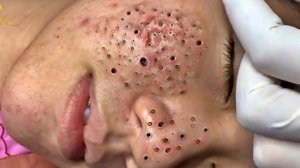 Выдавливание прыщей. Отличное качеств