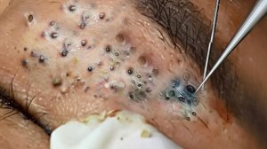 Удаление черных точек Отличное качество