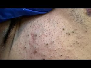 ASMR | Удаление черных и белых точек | Ежедневный уход и решения