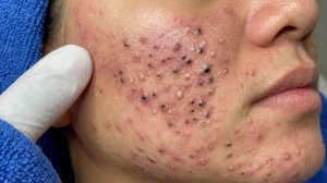 Удаление черных точек в Sac Dep Spa