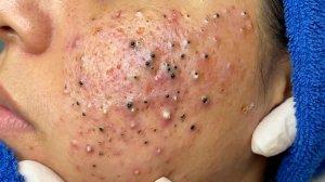 Удаление черных точек в Today Spa