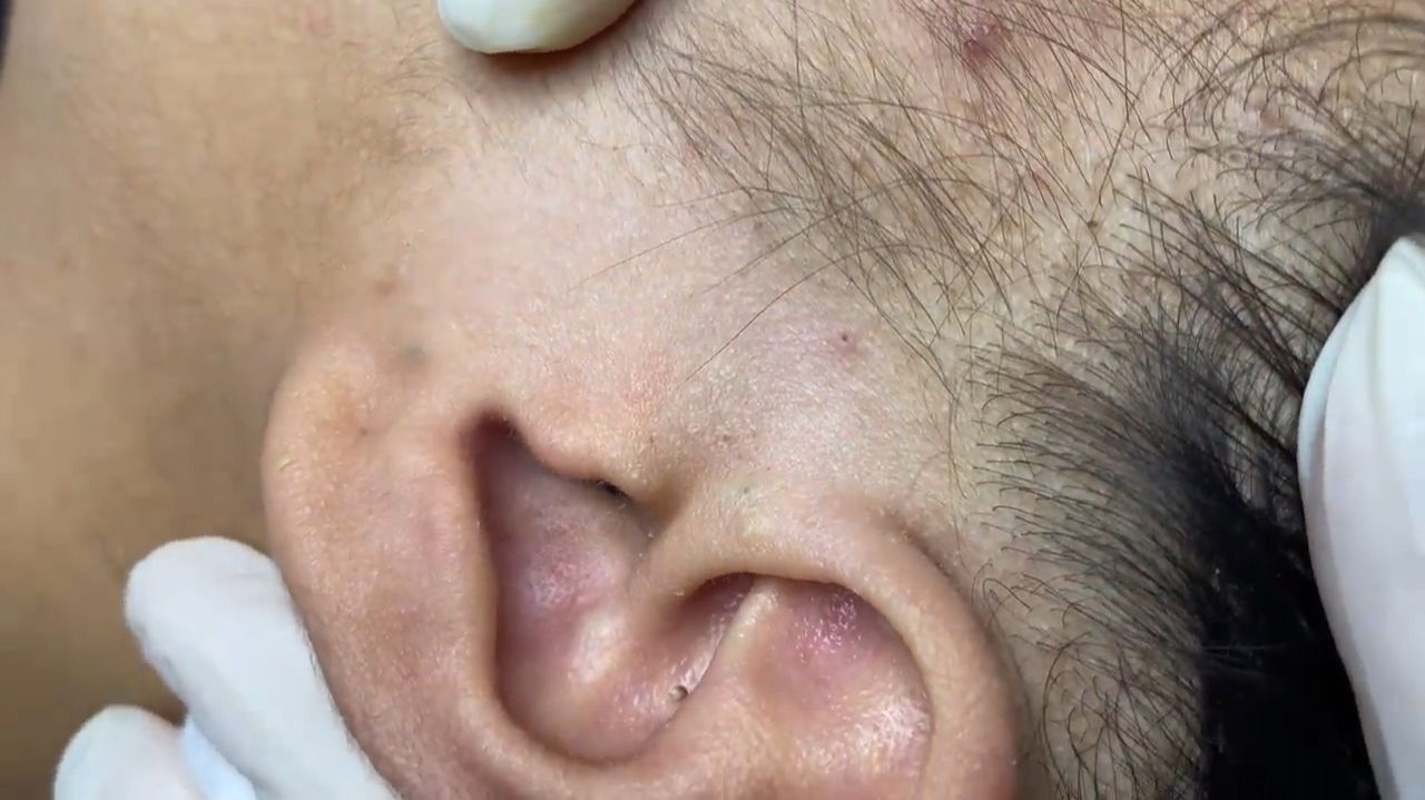 366 • Acne Collection • АСМР • Relax Spa