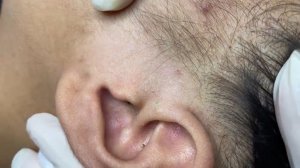 366 • Acne collection • АСМР • Relax Spa