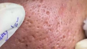 #1 Чистка лица: удаление черных точек, комедонов и прыщей