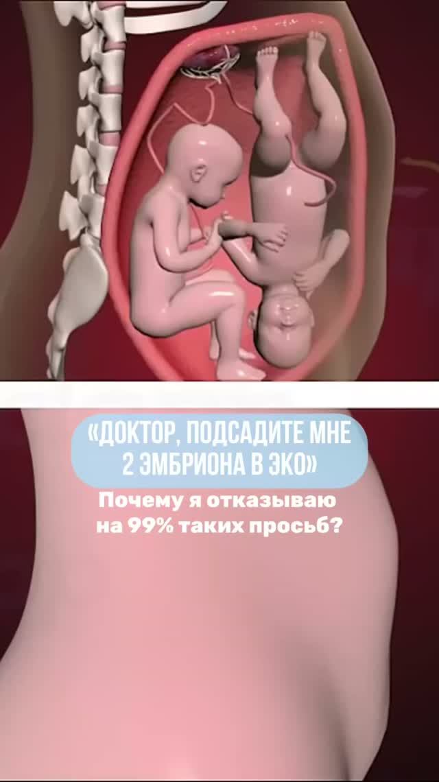 Почему я в 99% случаев отказываю в переносе двух эмбрионов?