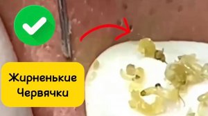 1,5 часа. Чистка лица от угрей и акне. Выдавливание прыщей. Удаление черных точек и комедонов