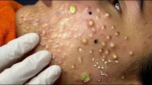 Выдавливание прыщей. Отличное качеств