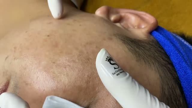 Удаление акне и чистка проблемной кожи смотреть онлайн