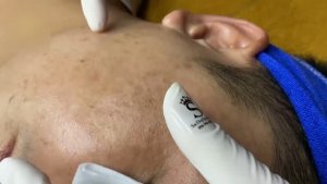 Удаление акне и чистка проблемной кожи