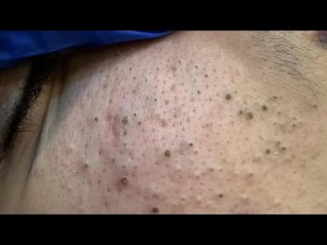 Глубокое очищение от черных точек | Уход за лицом для чистой кожи