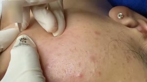 Удаление акне и черных точек на лице