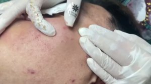 #4 Чистка лица: удаление черных точек, комедонов и прыщей