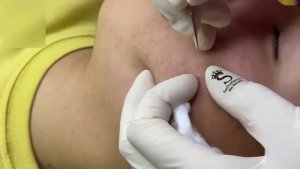 Выдавливание скрытых комедонов из щеки
