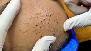 Удаление черных точек с Sac Dep Spa