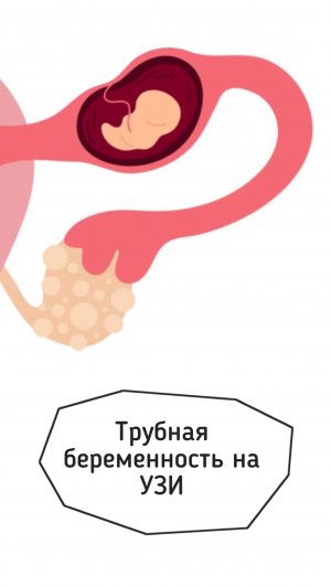Ультразвуковая картина внематочной (трубной) беременности