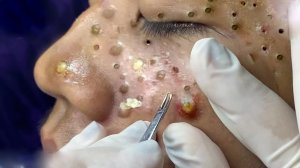 Экстремальное удаление черных точек: удовлетворение и расслабление