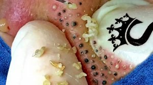 Удаление черных точек в Sac Dep Spa