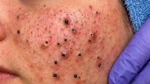 Удаление черных точек в Sac Dep Spa