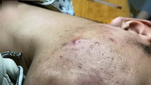 #659 Удаление акне. Экстракция комедонов. Подкожные прыщи. Чистка от черных точек
