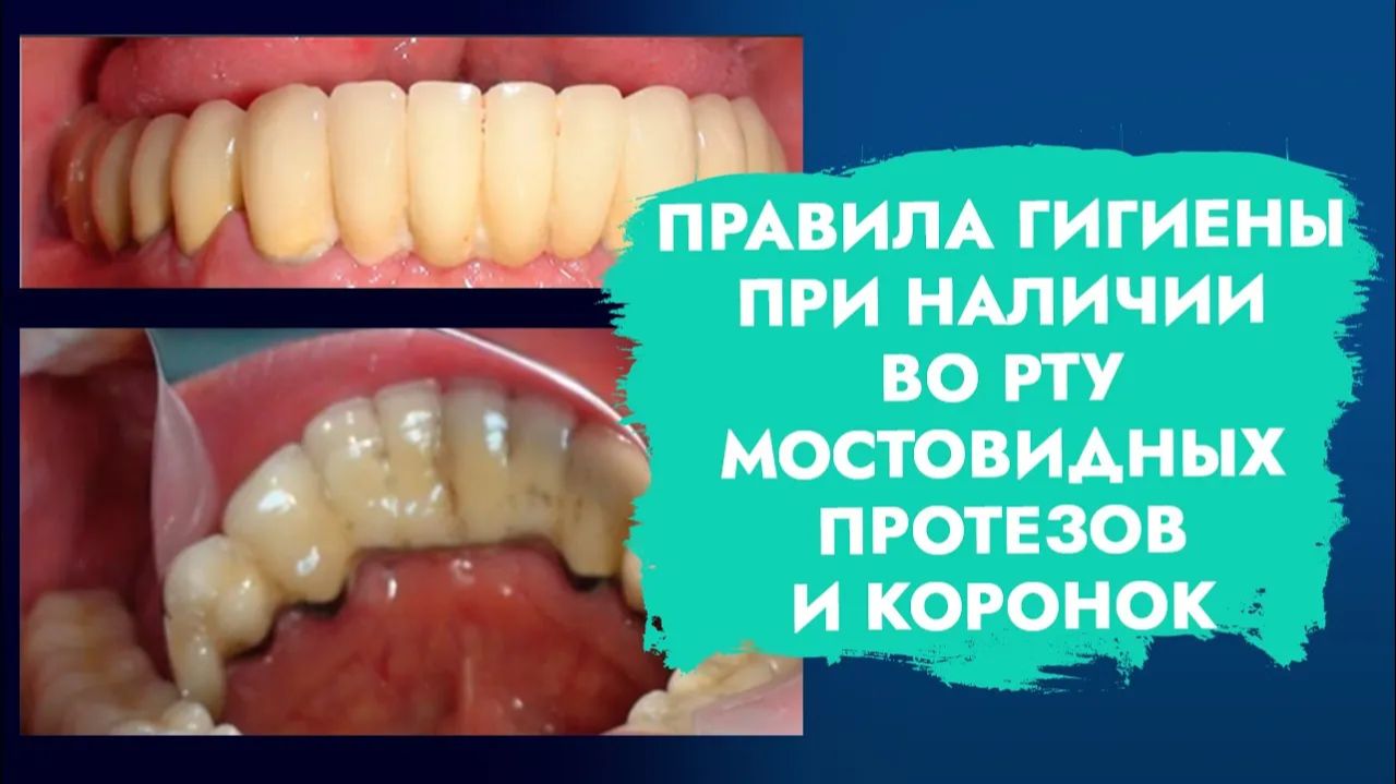 Уход за зубами, когда на них стоЯт коронки и мосты!