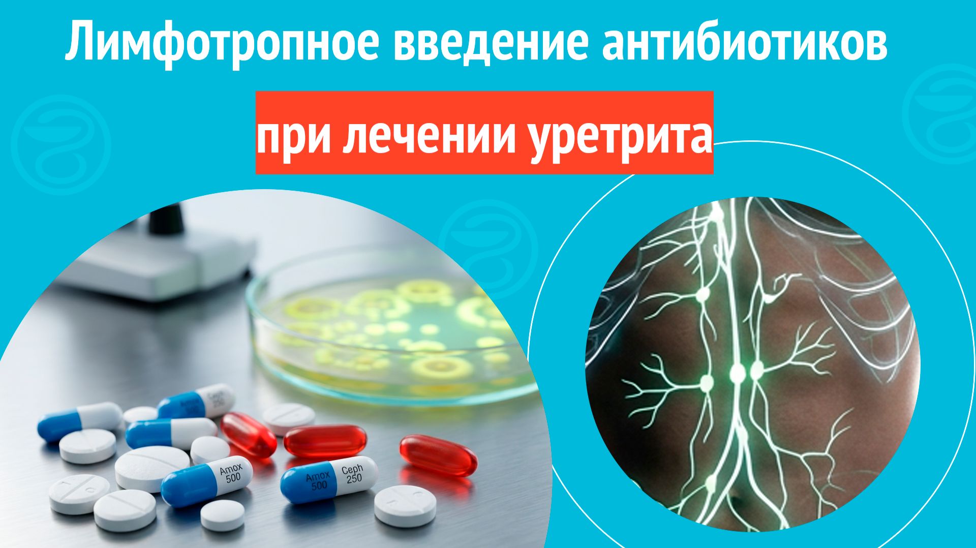 ✅ Лимфотропное введение антибиотиков при лечении уретрита. Клинический случай № 1824 (1)
