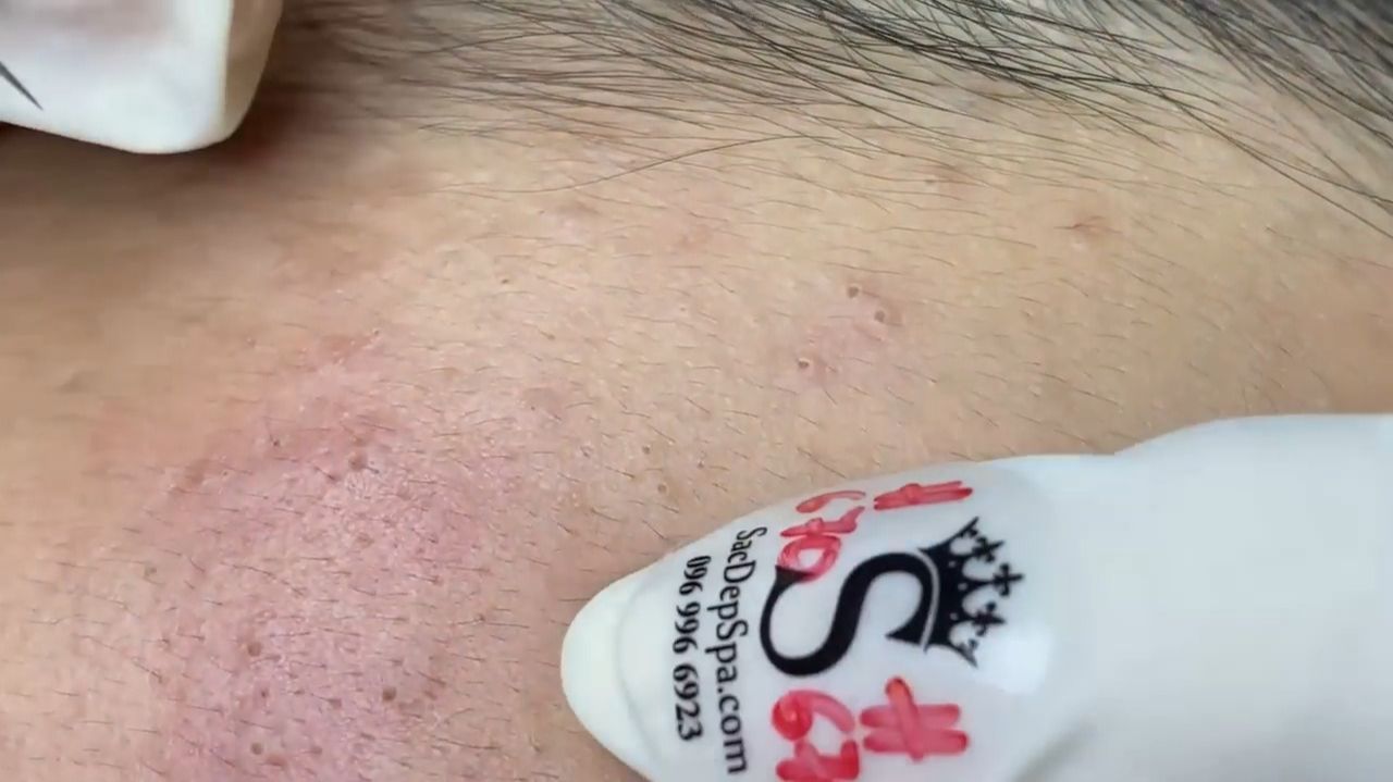 Acne Collection • A035 • Архив SacDepSpa • АСМР