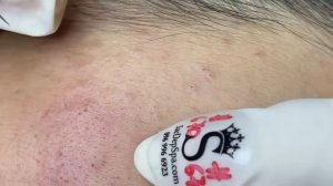 Acne collection • A035 • Архив SacDepSpa • АСМР
