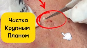 #1051 Чистка лица от угрей и акне. Выдавливание прыщей. Удаление черных точек и комедонов