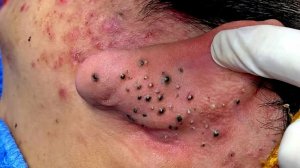 Удаление черных точек с Sac Dep Spa