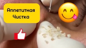 1,5 часа. Чистка лица от угрей и акне. Выдавливание прыщей. Удаление черных точек и комедонов