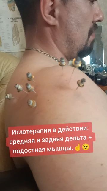 Иглотерапия в действии: средняя и задняя дельта + подостная мышцы.☝️😉
#костоправмосква #мануальная