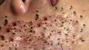 Экстремальное удаление черных точек: релакс и удовольствие