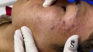 Чистка лица от закрытых комедонов и воспалительных элементов