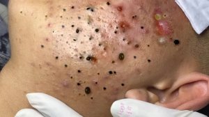 Экстремальное удаление черных точек: релакс и удовольствие