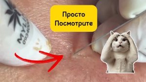 #1052 Чистка лица от угрей и акне. Выдавливание прыщей. Удаление черных точек и комедонов