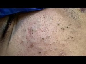 ASMR Приятное удаление черных точек и корейский уход для сияния