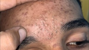 sac be spa face blackhead care for elderly men | skin care information new video 2027 | #320