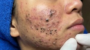 Удаление черных точек в Today Spa