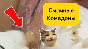 Больше часа #4. Чистка лица от угрей и акне. Выдавливание прыщей. Удаление черных точек и комедонов
