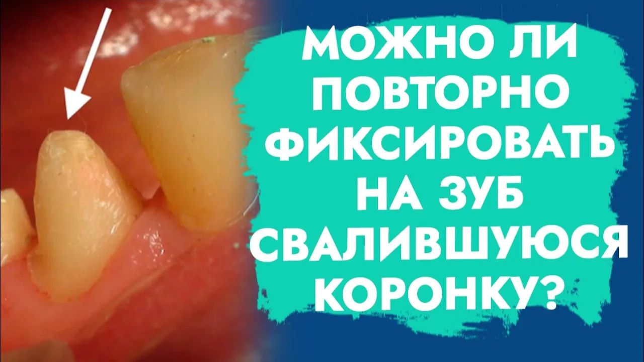 Свалилась коронка. Переделывать или поставить на место старую?
