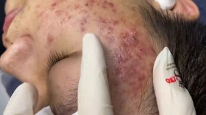 381 • Acne collection • АСМР • Relax Spa