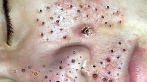 Выдавливание прыщей. Отличное качеств