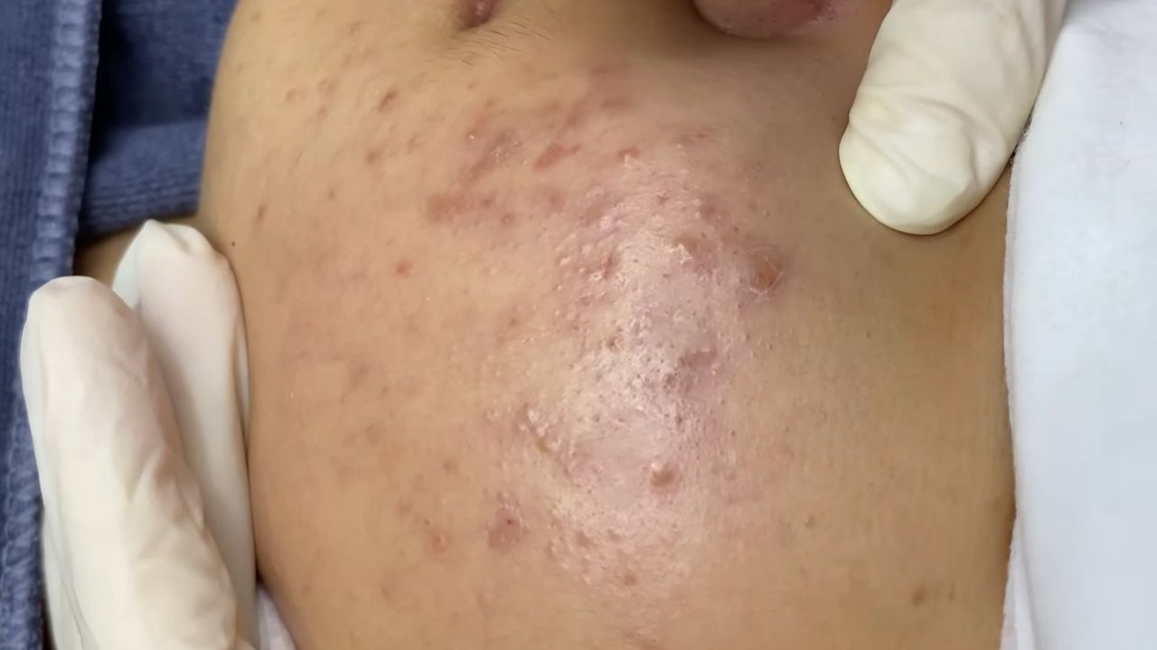 369 • Acne Collection • АСМР • Relax Spa