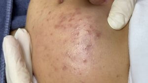 369 • Acne collection • АСМР • Relax Spa