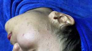 Лечение скрытых прыщей у девушки – удаление подкожных комедонов